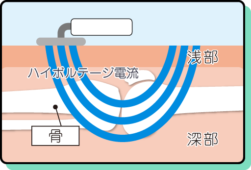 ハイボルテージが深部まで作用するイメージ図