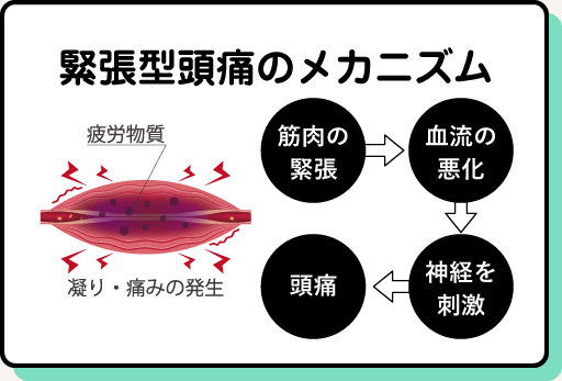 緊張型頭痛のメカニズム